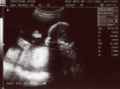 2008_0207_ElizabethUltrasound